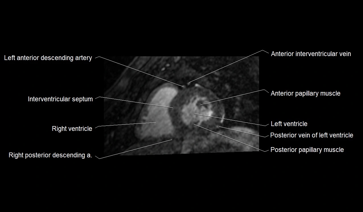MRI heart and coronary arteries short axis anatomy image 25.webp